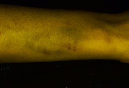 Bruise on the arm under ambient light